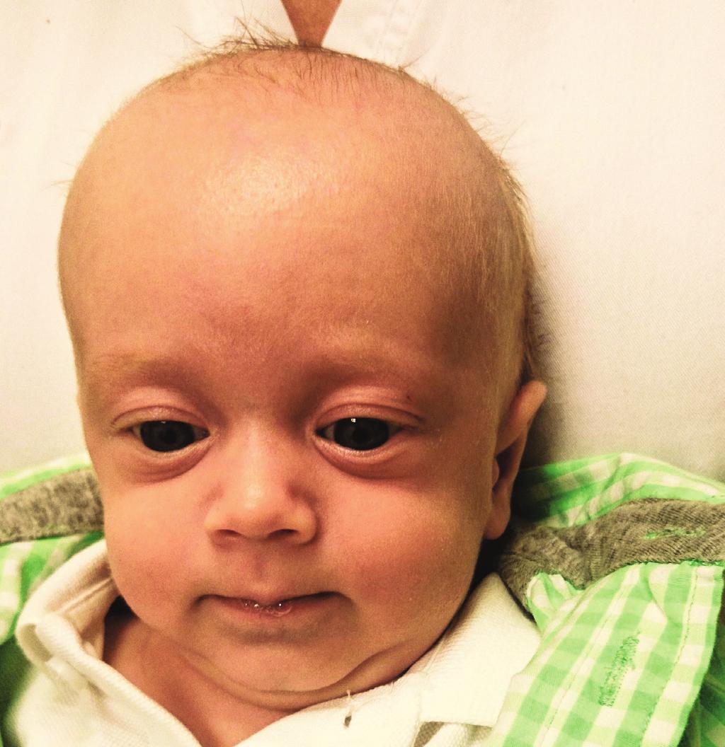 Neonatální thyreotoxikóza ZÁVĚR Ačkoliv je novorozenecká tyreotoxikóza vzácné onemocnění, je v případě známé tyreopatie matky jeho diagnostika snadná.