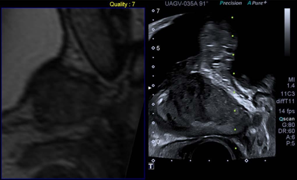 PŘEHLEDOVÝ ČLÁNEK 93 Synchronizované zobrazení prostaty v sagitální rovině, vlevo obraz mp MRI, vpravo transrektálního ultrazvuku.
