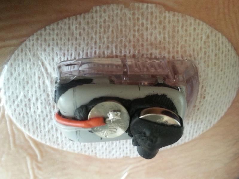 CGM Přesnost měření - pacienti věří cgm a neujistí se glukometrem, zda jsou hodnoty validní Špatná kalibrace kontrola paměti - data se po několika týdnech přemazávají používání prošlých senzorů,