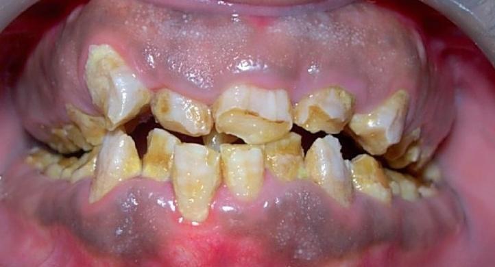 Obrázek 31 Hypokalcifikovaná Amelogenesis imperfecta (23) 5.