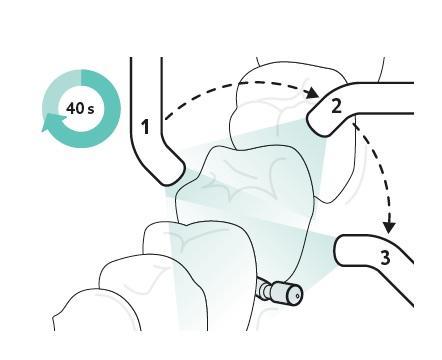 8. Infiltrát osvítíme pod UV světlem ze všech stran po dobu min. 40 sekund (celkem) (obr. 40). Obrázek 43 Osvícení pomocí UV (12) 9. Našroubujeme novou fólii a zavedeme do interdentálního prostoru.