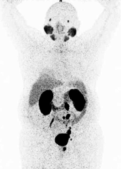 Obr. 1B Obr. 1A Obr. 1. PET/CT s Ga-PSMA11. A metastáza v jedné z pánevních uzlin vlevo; B celotrupový MIP obraz PET Fig. 1. PET/CT with Ga-PSMA-11.