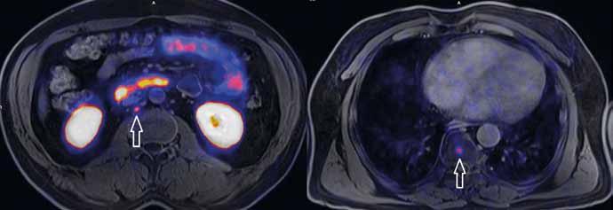 kostní metastáza; C celotrupový MIP obraz PET Fig. 2. PET/MRI with Ga-PSMA-11.