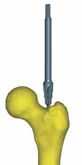 Popis implantátů Operační postup Instrumentárium Katalogová nabídka Operační technika implantace femorální komponenty.