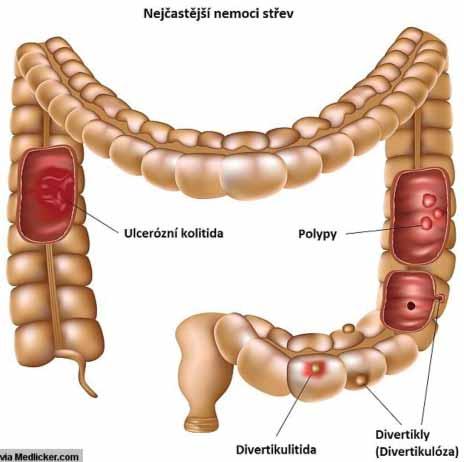 Co očekávat u kolonoskopie Jaké jsou možné komplikace a alternativy kolonoskopického vyšetření?