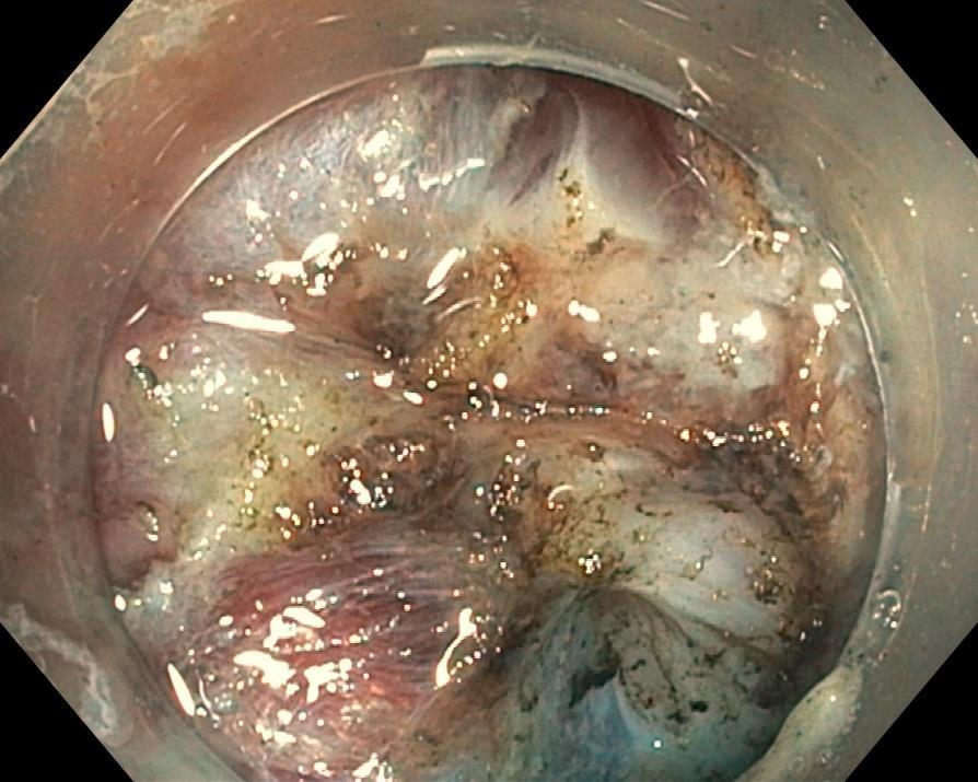 Obr. 41 Retrakce muscularis propria s