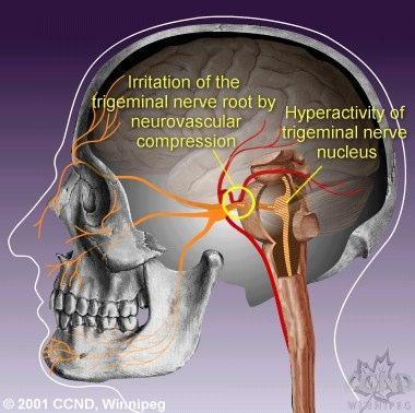 Sekundárna neuralgia vzniká pri dráždení nervu rôznymi chorobnými procesmi v priebehu n. trigeminus. Najčastejšie príčiny sekundárnej neuralgie nervus trigeminus: meningeóm alebo schwannom n. VIII.