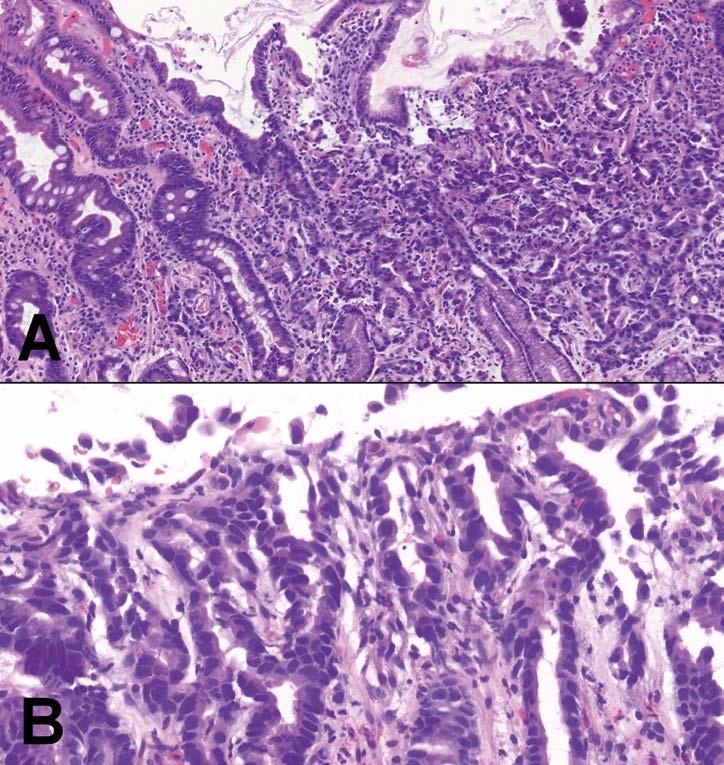 Obr. 1. Chronická gastritida s ložiskem atrofie a intestinální metaplazie (levá třetina obrázku), s dysplazií a časným tubulárním adenokarcinomem (pravá třetina obrázku).