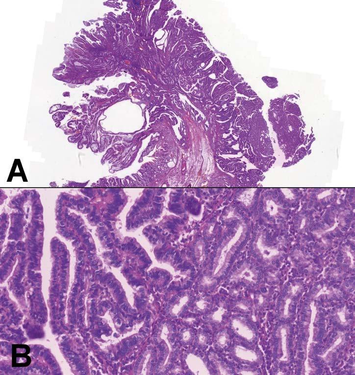 Obr. 4. (A) Adenom z pylorických žlázek s intestinální metaplazií a kombinovanou dysplazií intestinálního a foveolárního typu.