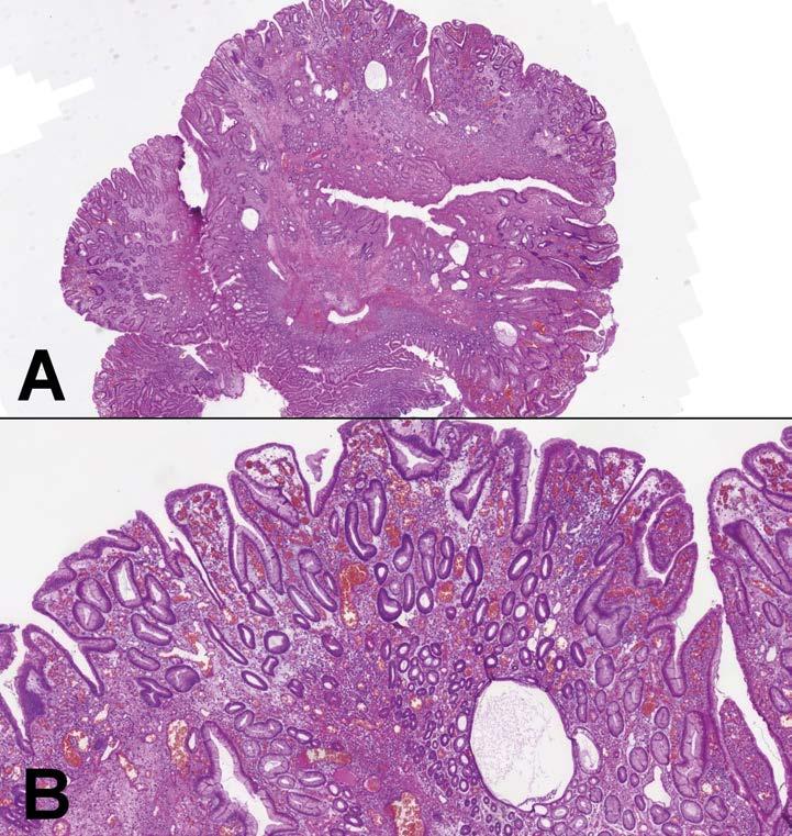Obr. 5. (A) Hyperplastický polyp. (B) Tato léze je tvořená hyperplastickým foveolárním epitelem s cysticky dilatovanými žlázkami v edematózním a zánětlivě infiltrovaném stromatu.