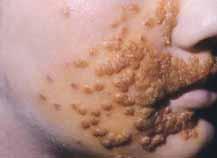 practicus odborný časopis praktických lékařů Glukokortikosteroidy v lokální aplikaci MUDr. Milena Jirásková, CSc. Dermatovenerologická klinika, 1.