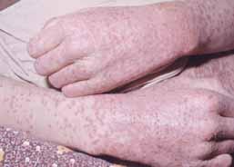 odborný časopis praktických lékařů practicus Generalizace herpes viru účinnými přípravky). Nicméně, pokud indikující nemá správně stanovenou diagnózu, je taková terapie rozhodně nevhodná.