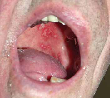 practicus odborný časopis praktických lékařů komedony, xantomy, mília, lichen sclerosus, lichen planus, pseudolymfomy, granuloma anulare, tinea, folliculitis, akneiformní výsevy, furunkulóza,