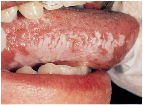 Mukositida = poškození sliznic GIT Dutina ústní: bolest Jícen: pálení žáhy,