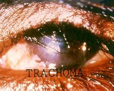 Trachom http://microbewiki.