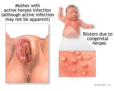 Herpes