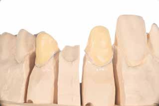 (Pokud má základ specifické oblasti menší tloušťku než je doporučená tloušťka pro konstrukci, dentinový porcelán se nesmí používat).