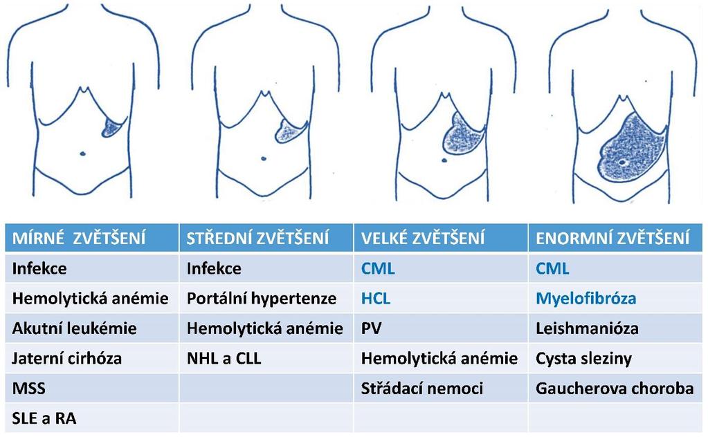 leukemie, PLL prolymfocytová leukemie, WM - Waldenströmova makroglobulinémie, HCL vlasatobuněčná leukemie, AML akutní myeloidní leukemie, ALL akutní lymfoblastická leukemie, CMML- chronická