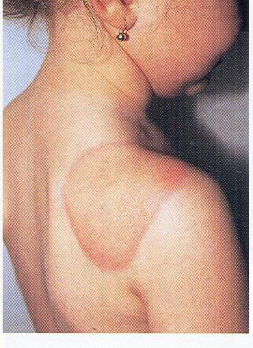 Erythema chronicum