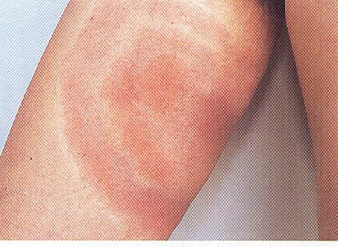 Erythema