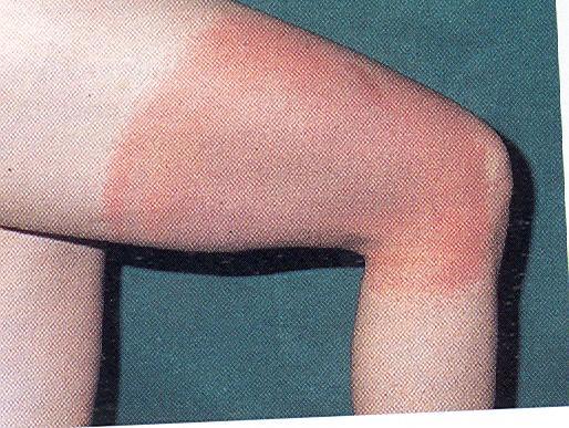 Erythema