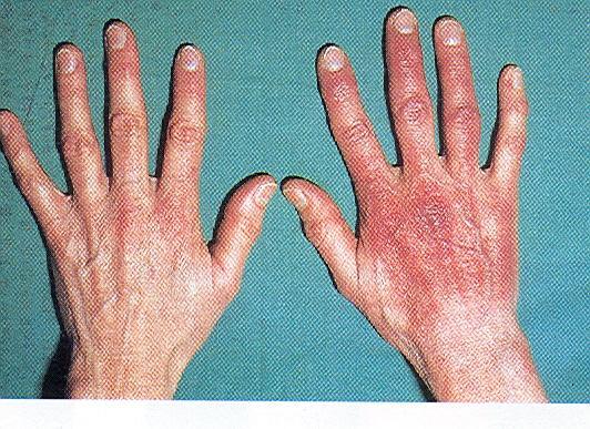 Acrodermatitis chronica