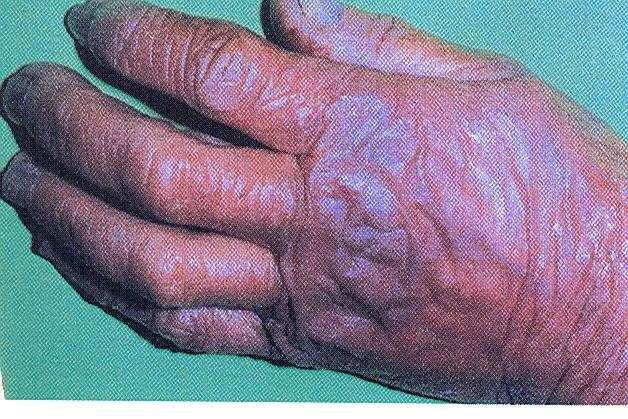 Acrodermatitis chronica