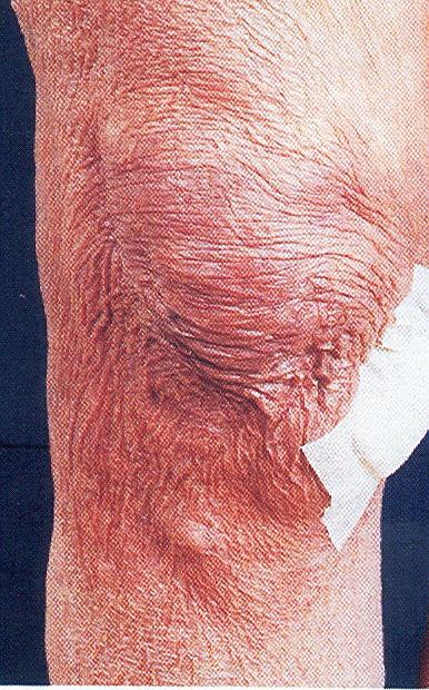Acrodermatitis chronica