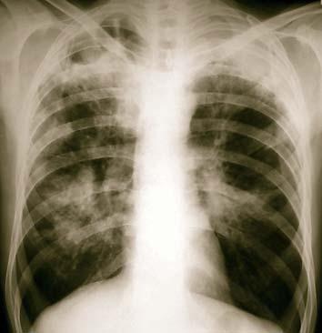 z nich jsou neškodné mikroorganizmy, vyskytující se všude kolem nás v půdě, vodě, na rostlinách. Několik druhů (např. Mycobacterium avium, M. xenopi, M. kansasii, M.