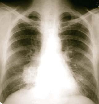 Rentgenový snímek zhoubného novotvaru plic (archiv) Kromě této čistě odborné medicínské aktivity se začínají v 90.letech objevovat nestátní sdružení pomáhající v boji proti nádorům.