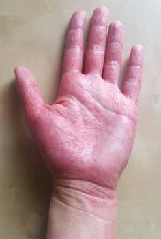 Alergická kontaktní dermatitida Alergická kontaktní dermatitida (ACD) je zánětlivé kožní onemocnění, jehož podstatou je opožděný typ hypersenzitivní reakce.