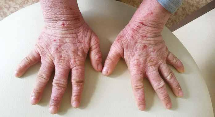 Alergická kontaktní dermatitida byla dříve považována za onemocnění především dospělých, často jako profesionální dermatóza.