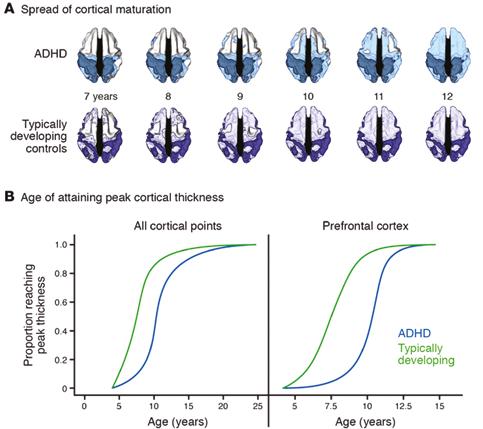 Prehľadové články 15 Obr. 1. Zpoždění maturace kortexu u dětí s ADHD ve srovnání se zdravými (Převzato z práce Shaw et al.