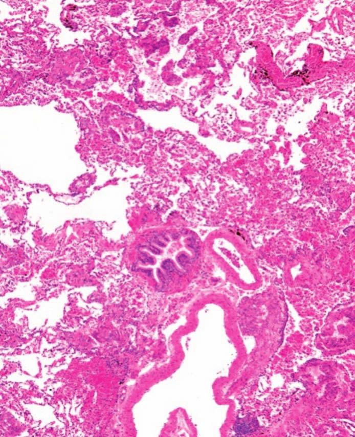 3: Angiomyolipomy levé ledviny Zdroj obrázku: archiv autorů Zdroj obrázku: archiv autorů Biopsie Definitivní potvrzení diagnózy LAM přinese až histopatologické vyšetření postižené tkáně.