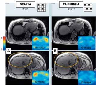 Difference between conventional undersampling of 3D sequences using GRAPPA/SENSE (A) interleaved under-sampling in case of CAIP- IRINHA (B).