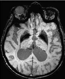 A visualization of the dilatated venous system in left hemisphere during acute migraine; B multiple micro-hemorrhage in older patient; C iron deposits in basal ganglia Obr. 24 