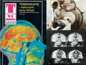 Obr. 1 Obr. 1. Pravděpodobně první zmínka o tomografu MR v českém písemnictví: T-magazín z roku 1984 (tehdy se ještě používalo označení NMR).