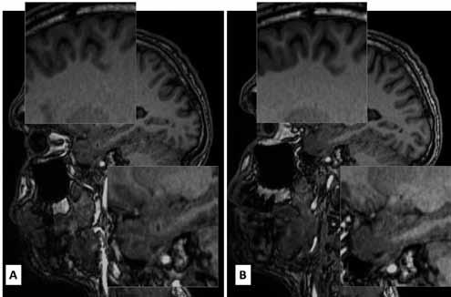 Comparison of using 20-channel (A) and 64-channel headneck RF coil (B) in brain MRI with T1-weighted images of the 3D MP- RAGE sequence. Profit in SNR is visible especially on surface of the brain.