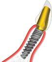 NARROW IMPLANTÁTY s vnitřním šestihranem kónické Ø 3. mm Řešení implantace v úzkých alveolech NICE má moderní design tenkého implantátu.