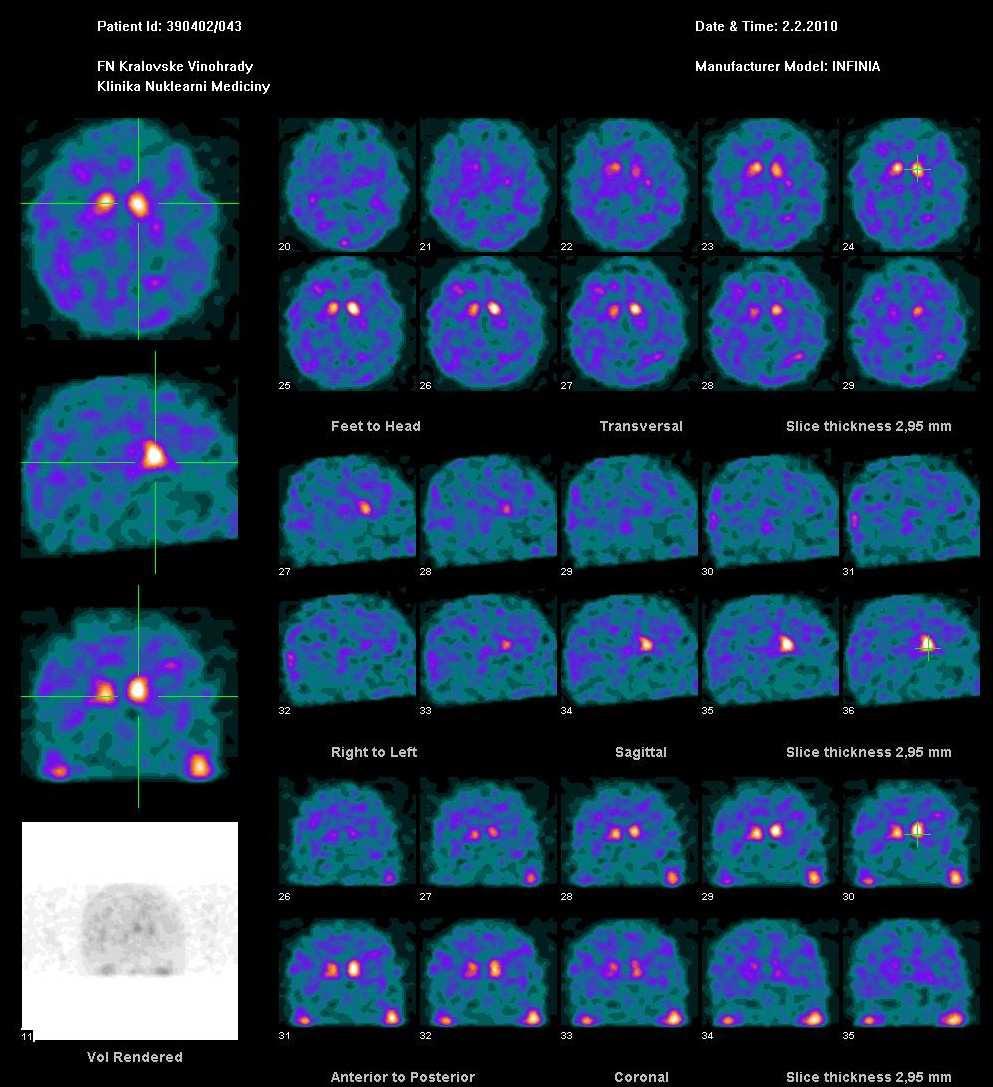 DaTSCAN -