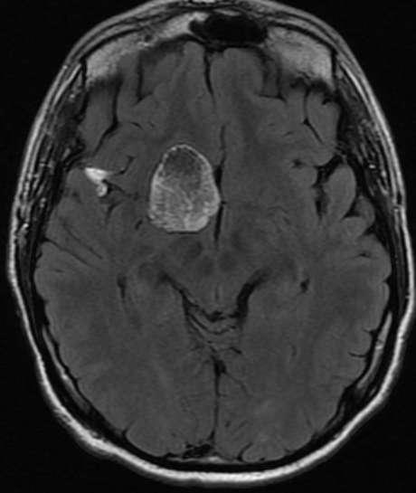 Craniofaryngeom