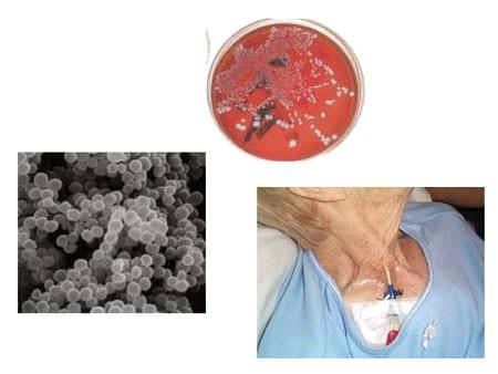 Prevence infekce žilních vstupů I při ošetřování žilních vstupů lze použít lokální antibiotika