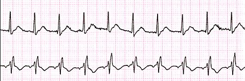 KASUISTIKA 75 letý muž, ICHS, RBBB, indikovaný k femoropopliteálnímu bypassu vlevo pro ICHDK. L epidurální anestezie s katétrem, bupivacaine 0.