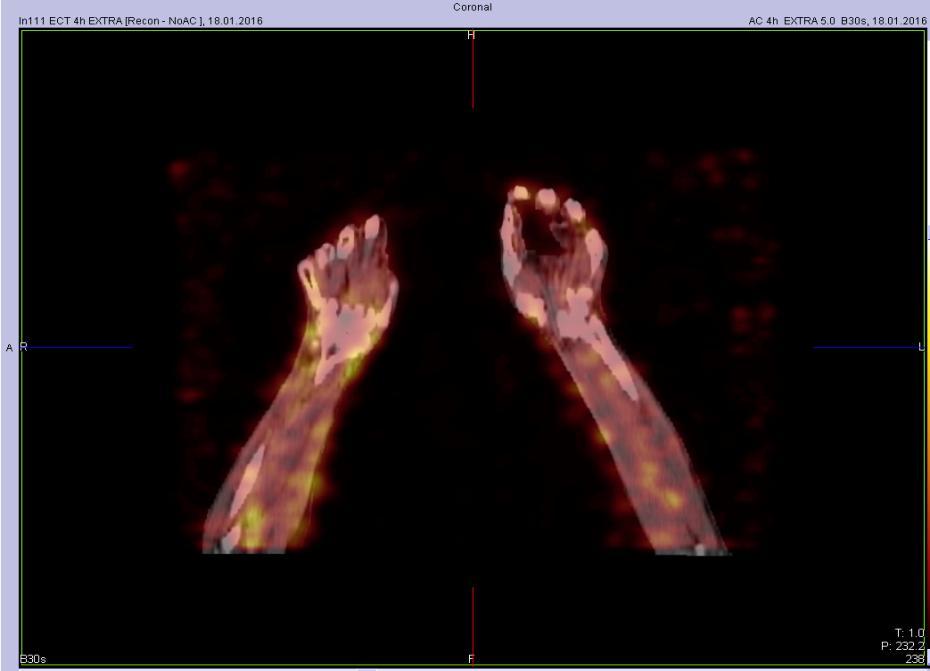 Příbram Obrázek 14 Fúze SPECT/CT oblast zápěstí za