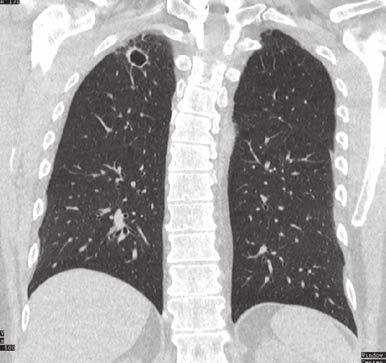 Atypická tuberkulóza (Mycobacterium kansasii) Jarmil Šafránek 1, Olga Růžičková Kirchnerová 2 1 Chirurgická klinika, FN Plzeň 2 Klinika pneumologie a ftizeologie, FN Plzeň Souhrn Kazuistika se týká