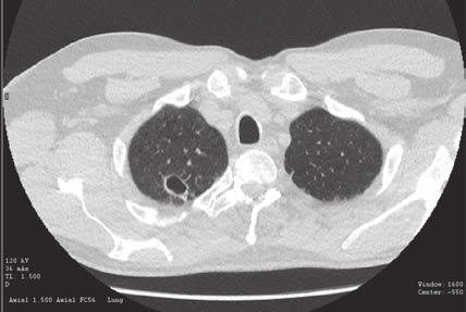 ATYPICKÁ TUBERKULÓZA (MYCOBACTERIUM KANSASII) Obr. 2: CT zobrazení plicní léze žením hrudní drenáže byl proto výkon ukončen. Nemocný byl pak poprvé izolován, zatím na chirurgickém pracovišti.