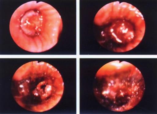 STRUČNÁ HISTORIE BRONCHOSKOPIE V OLÚ JEVÍČKO (1916 2016) Už tehdy ale profesor Killian předpověděl velký význam bronchoskopie pro diagnostiku onemocnění dýchacích cest a plic, zvláště pro diagnostiku