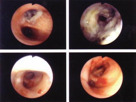 2: Endobronchiálně rostoucí nádor efekt laserové a mechanické desobliterace Obr. 8.3: Atelektáza pravého plicního křídla Obr. 8.4: Stav po laserové rekanalizaci pravého bronchiálního systému Obr.