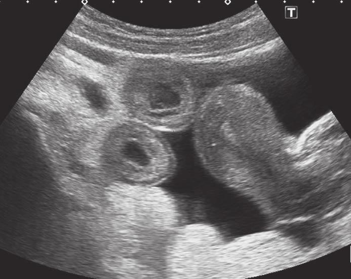 HEREDITÁRNÍ ANGIOEDÉM, STÁLE OPOMÍJENÁ DIAGNÓZA Obr. 3: Sonografické vyšetření břicha pacientky kazuistika 2. Úsečka A označuje ztluštění stěny tenkého střeva v ileocekální oblasti. Tab.