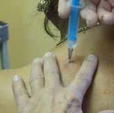 Postačí krátká a slabá kožní jehla a 1-2 ml l% Mesocainu.